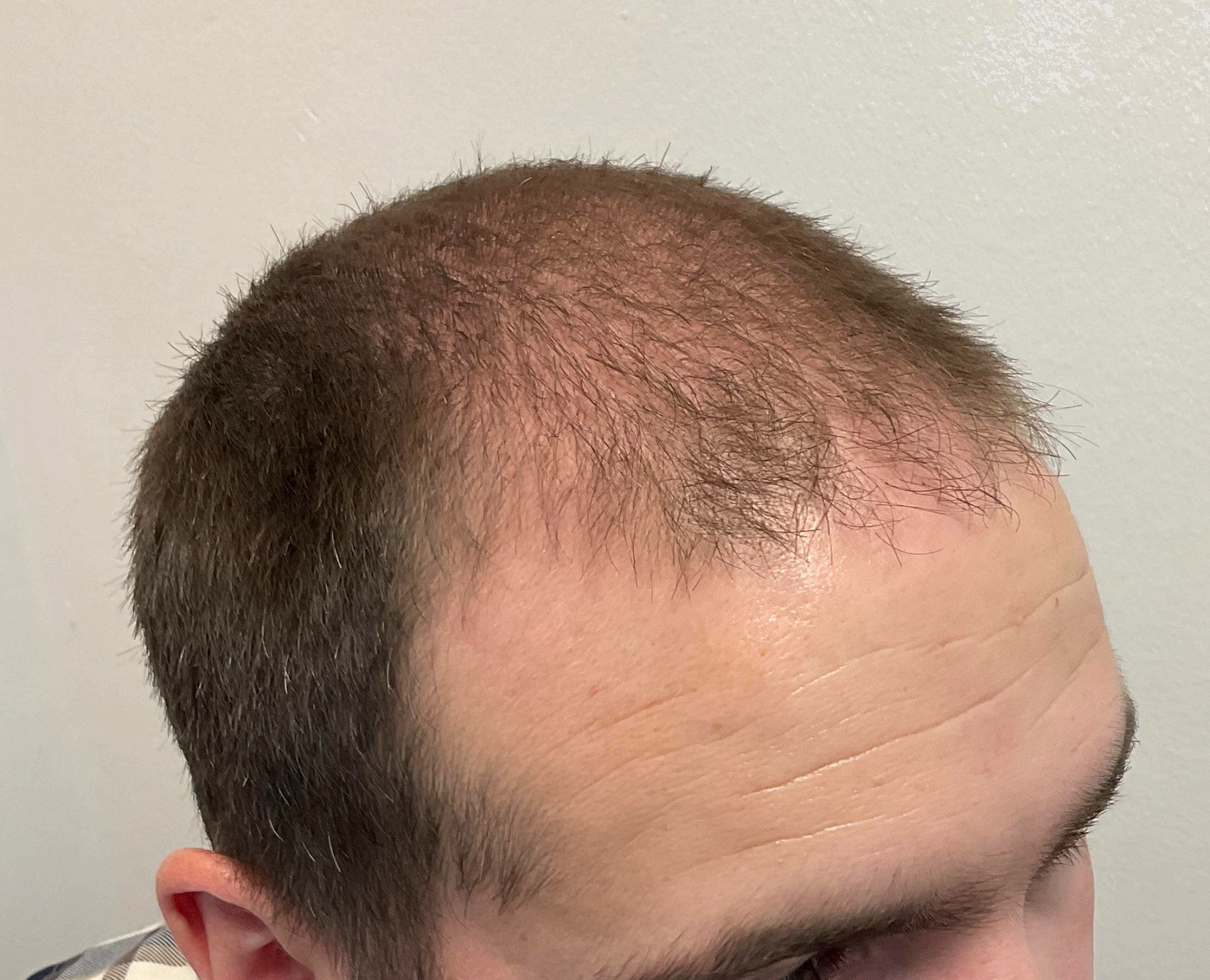 Roman — before hair transplant