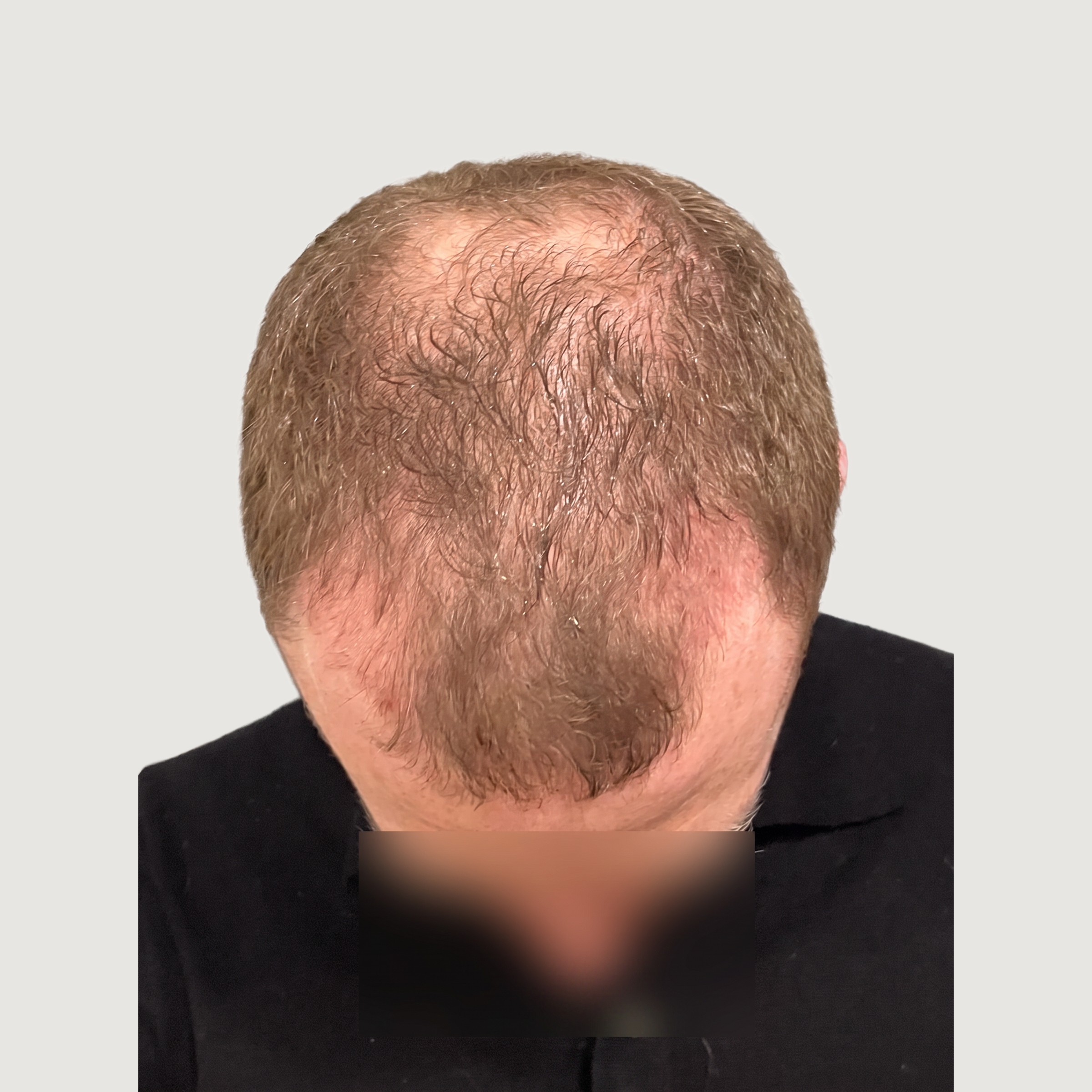 Before Treatment — The Starting Point
