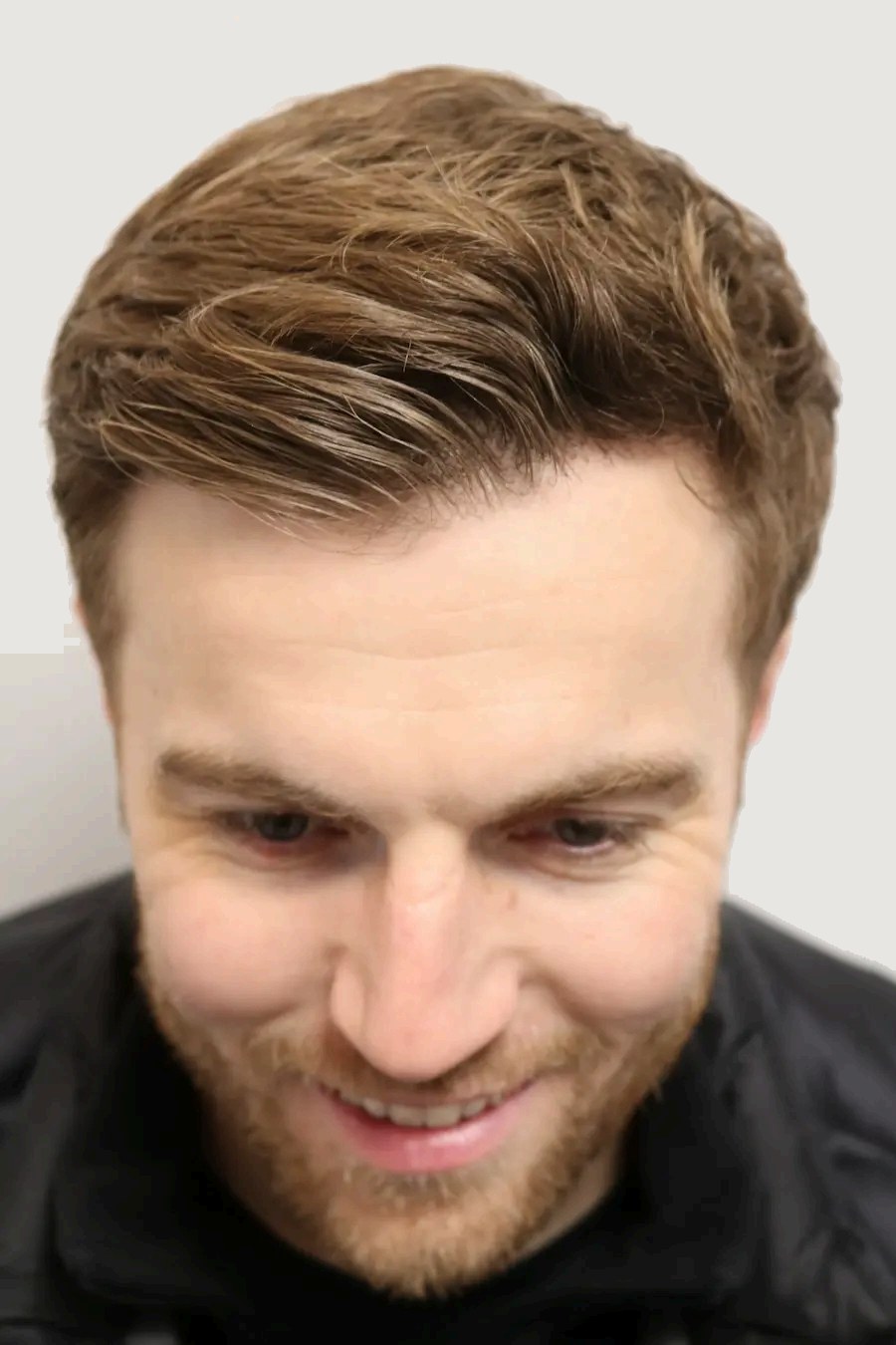 Lewis — after hair transplant