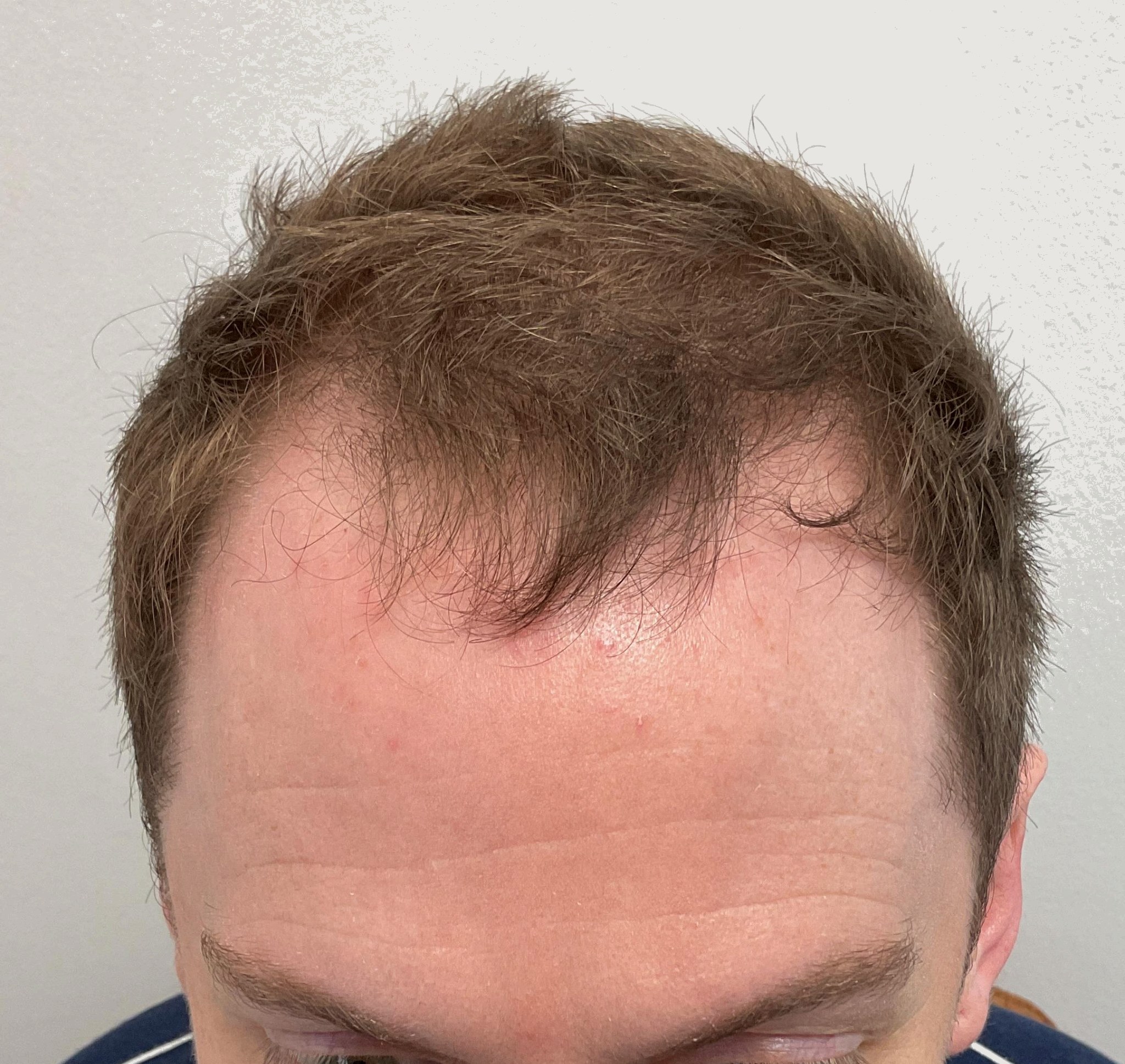 Sean — before hair transplant