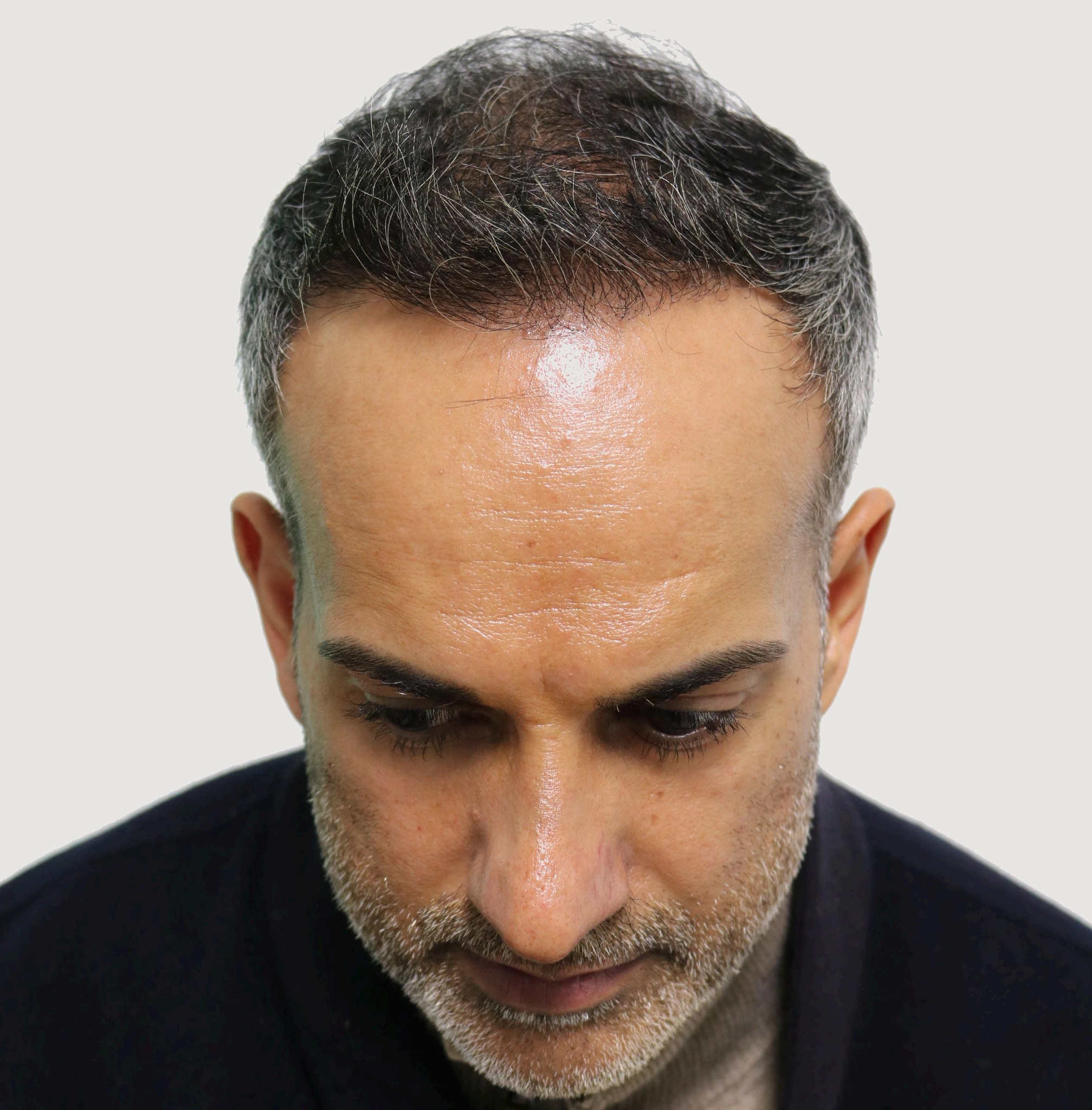Aman — after hair transplant