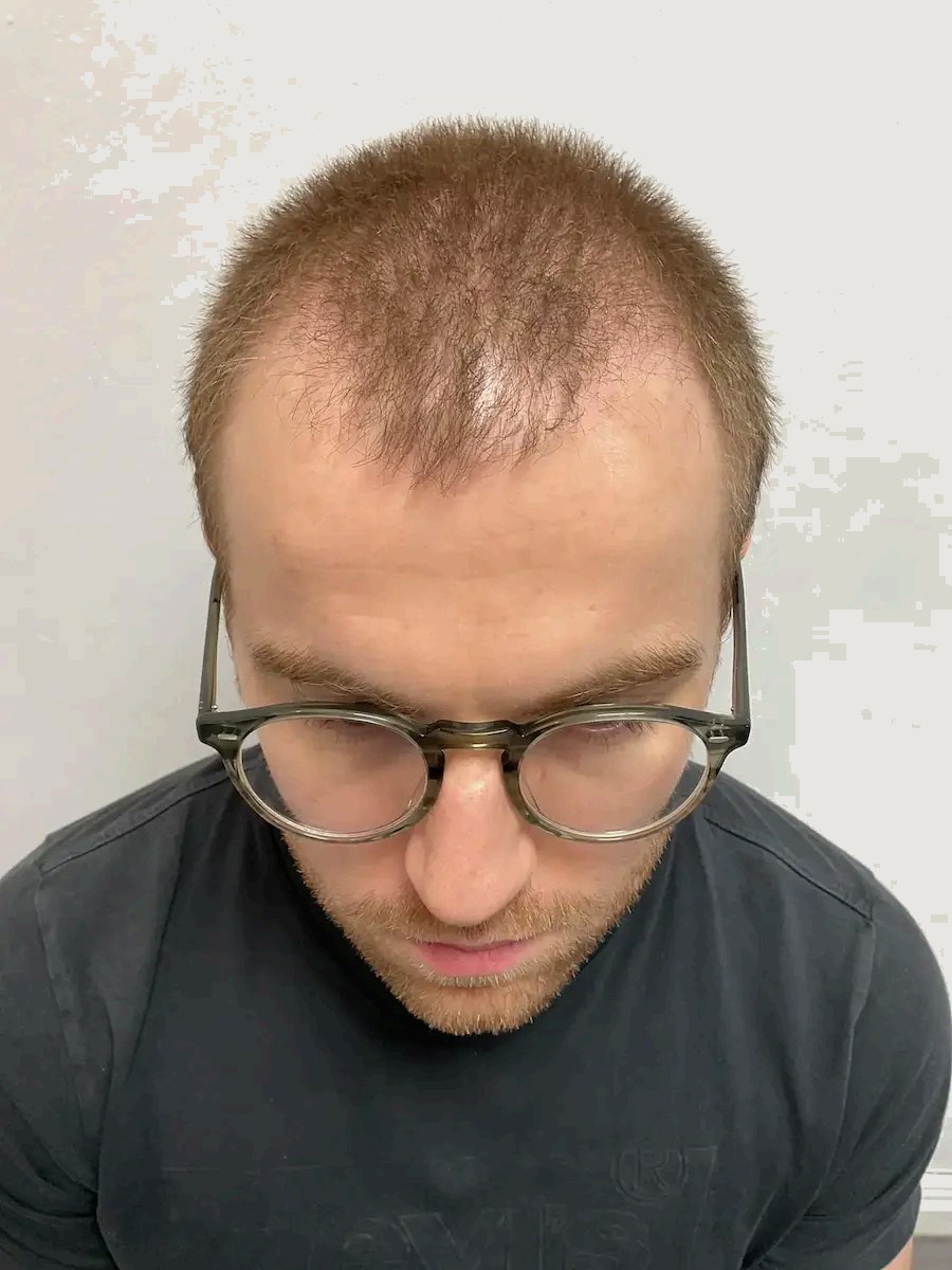 Lewis — before hair transplant