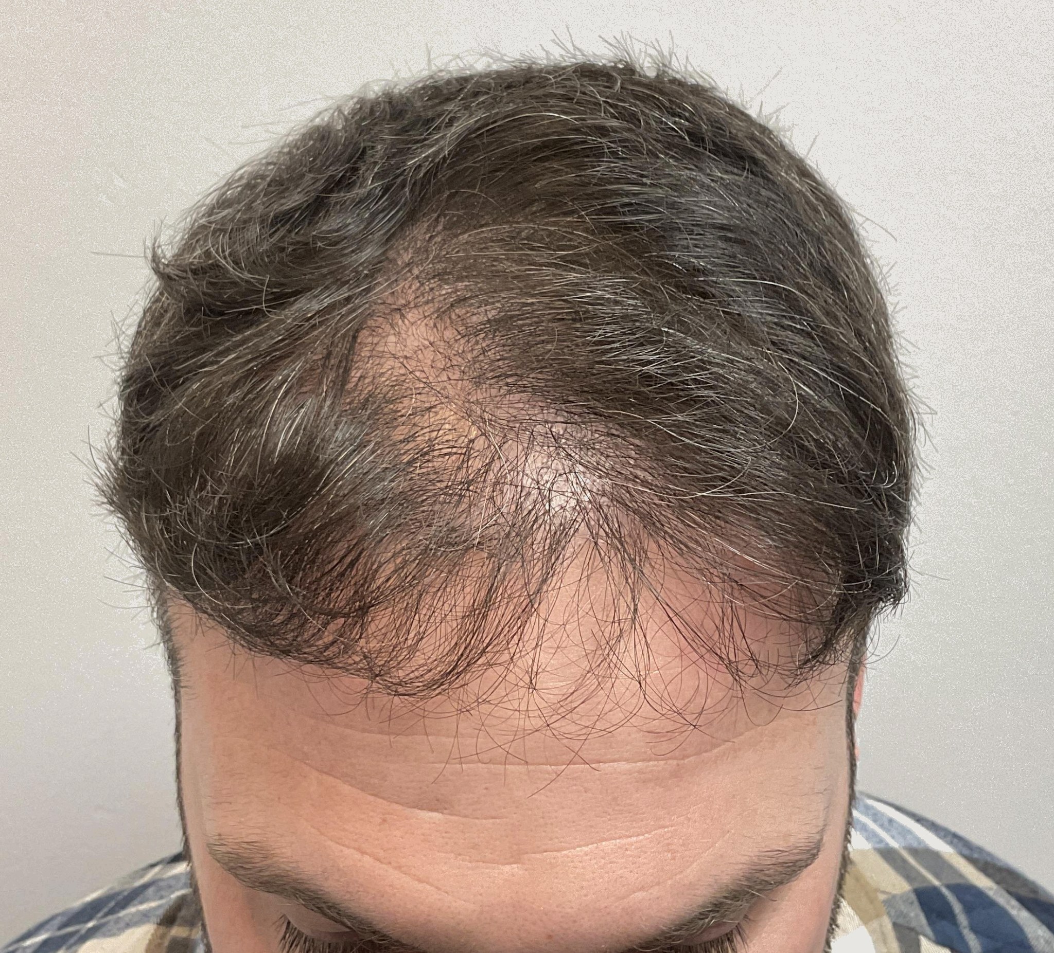 Anton — before hair transplant