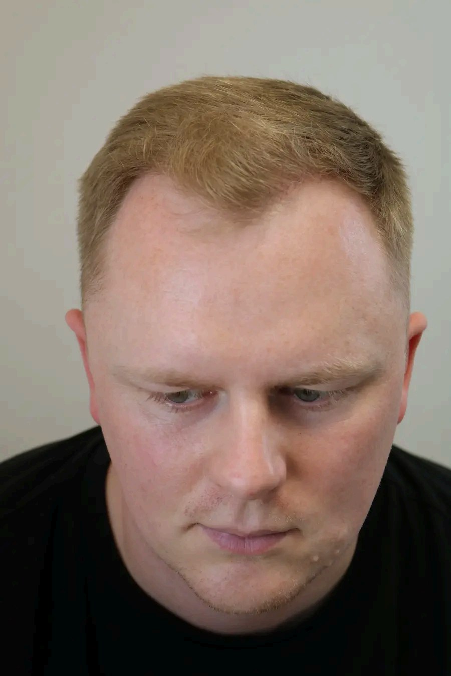 Tyler — after hair transplant