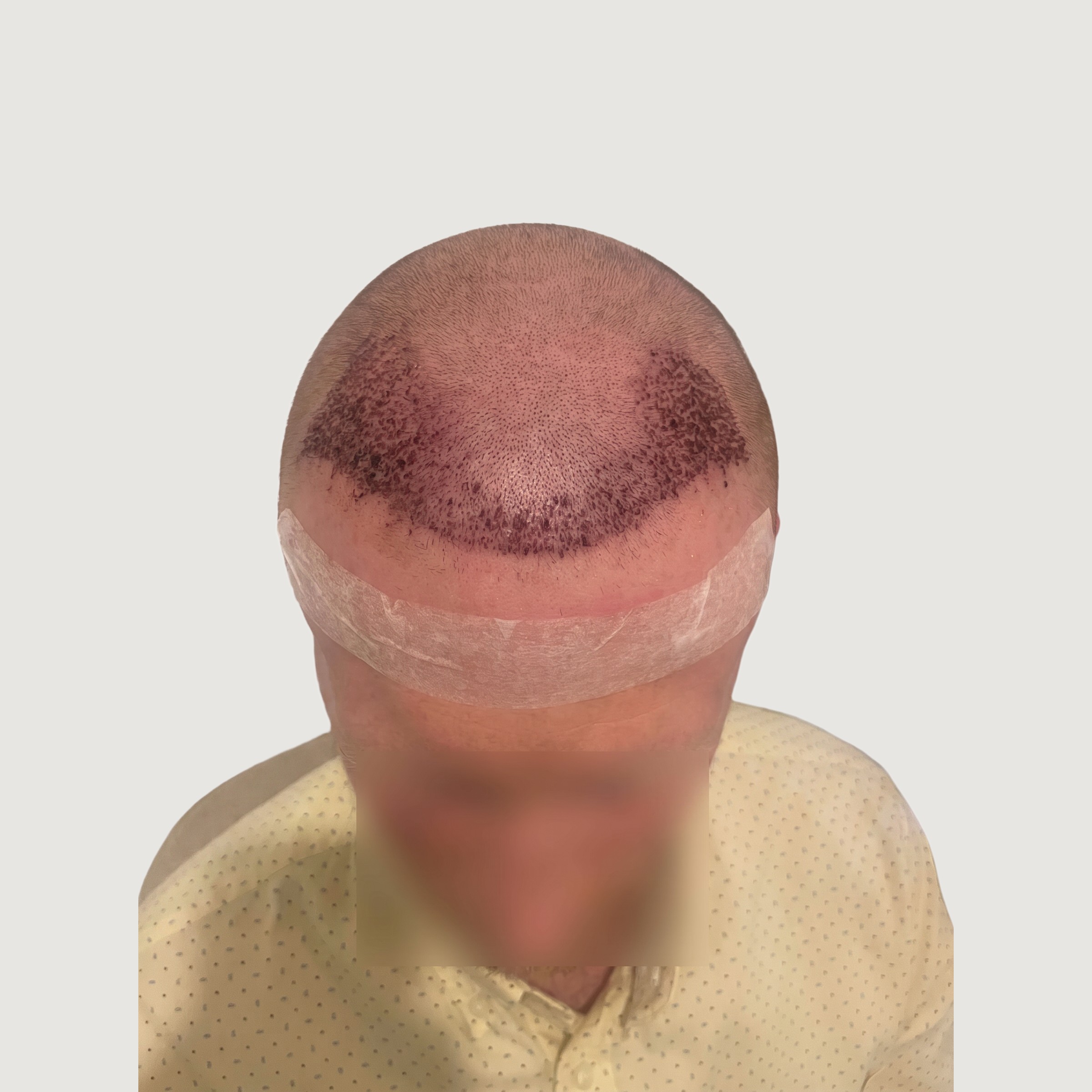 Hair Transplant Complete — Day 1 — The Foundation Has Been Created