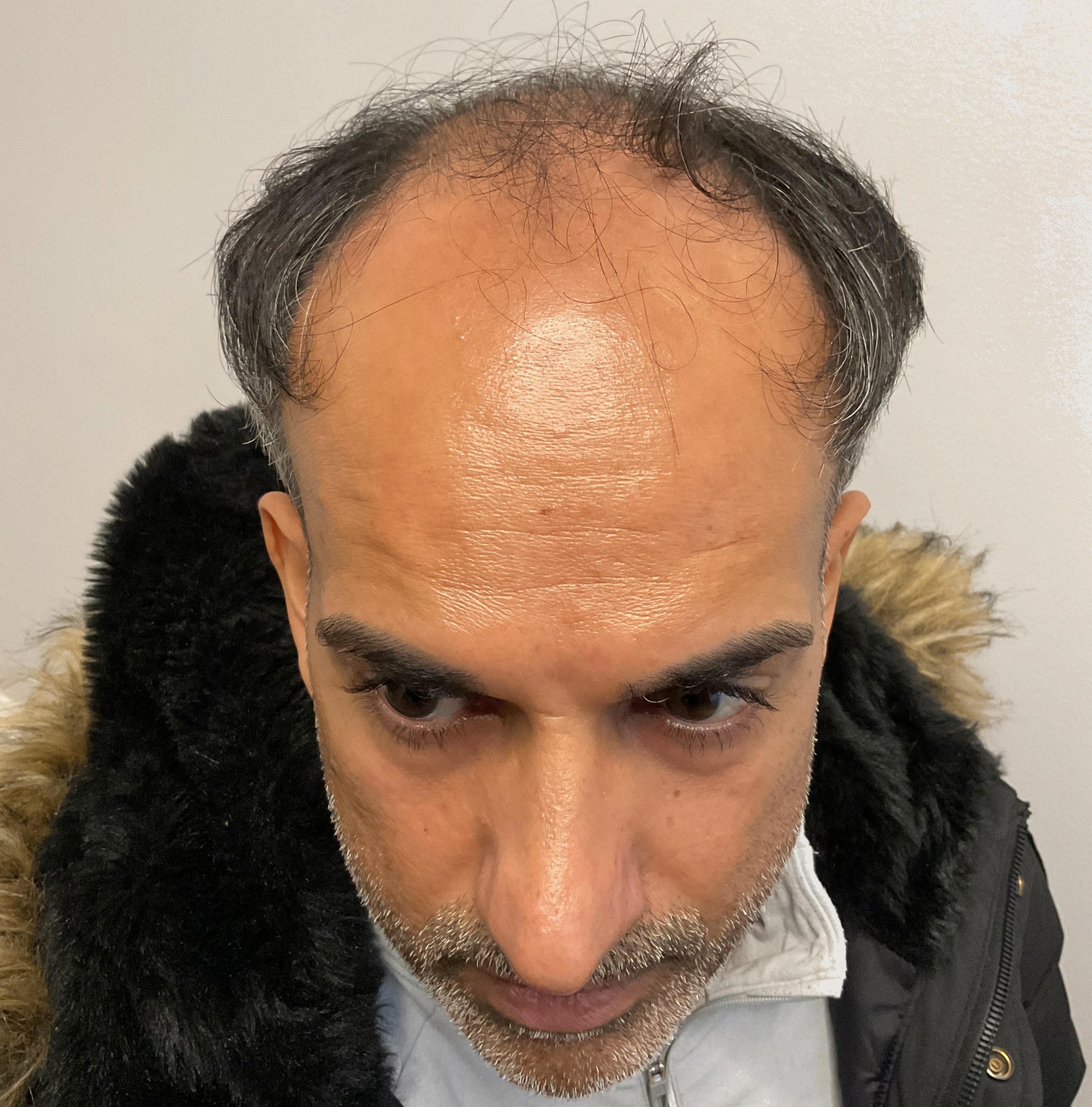 Aman — before hair transplant