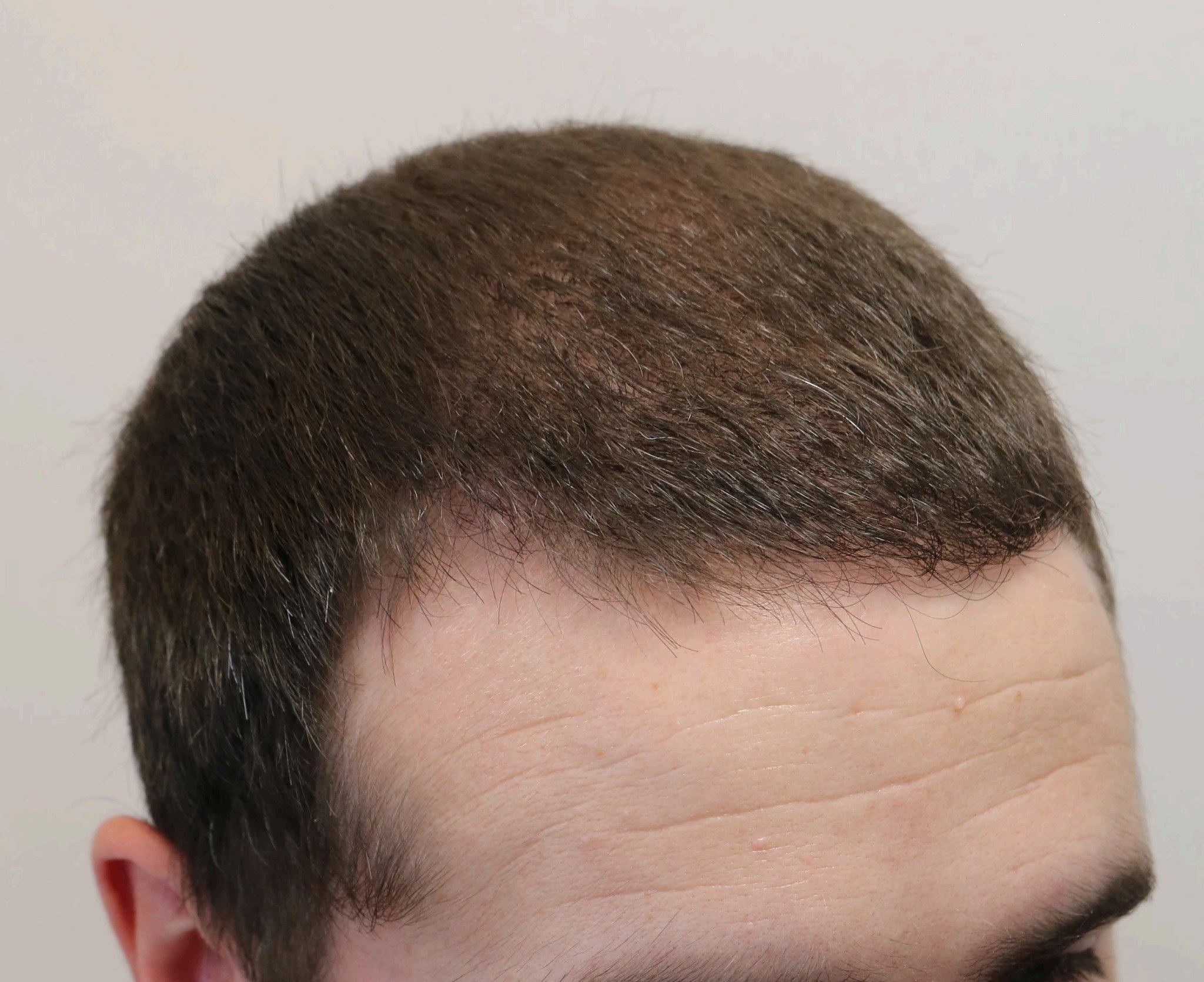Roman — after hair transplant