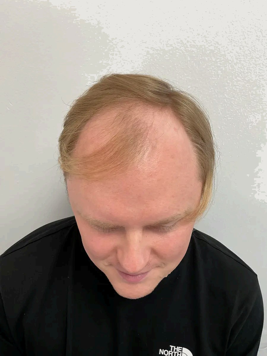 Tyler — before hair transplant