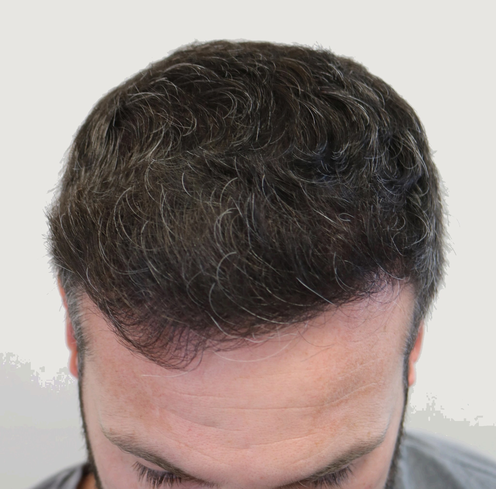 Anton — after hair transplant