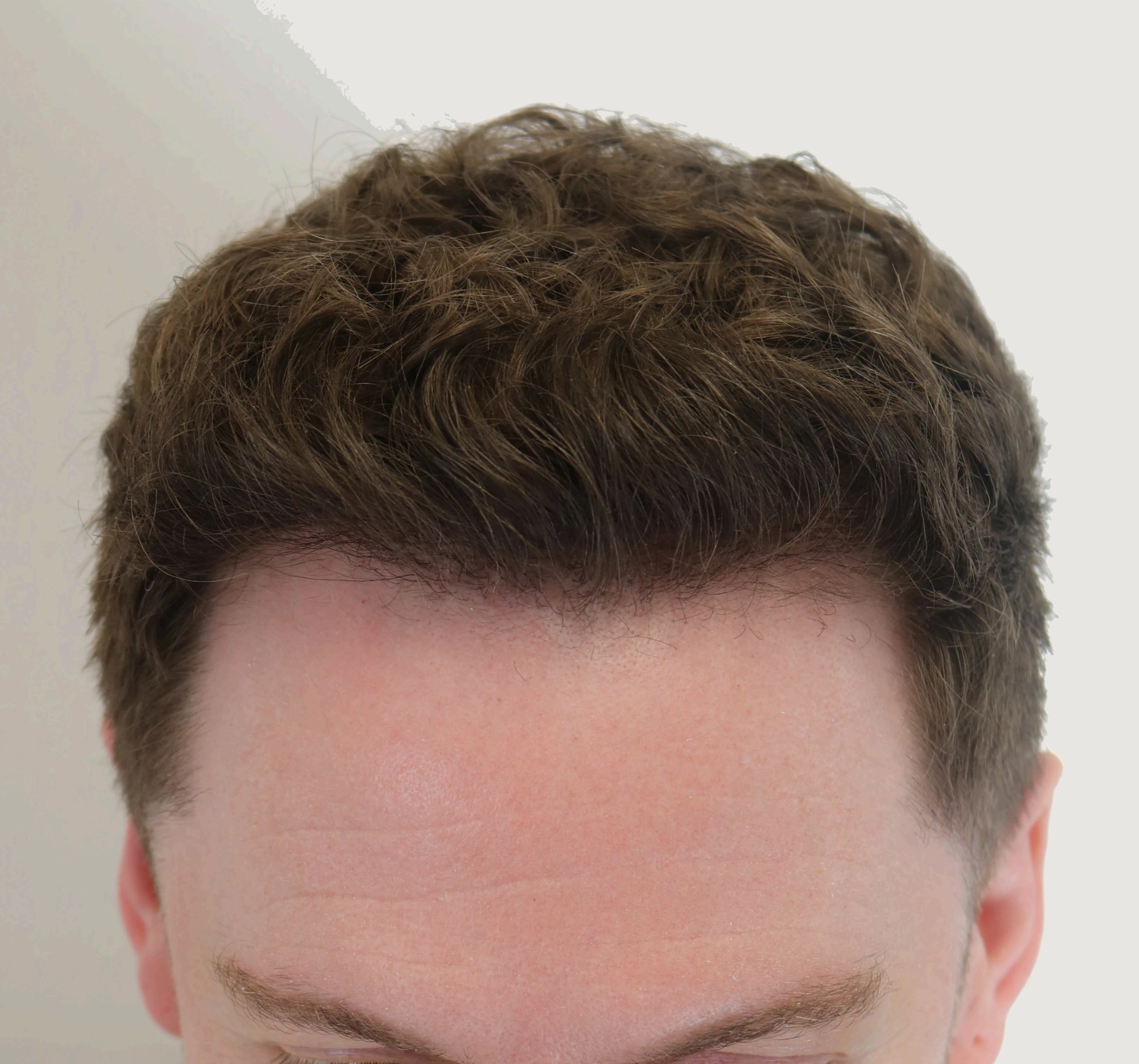 Sean — after hair transplant