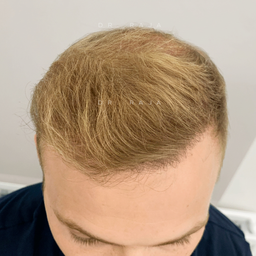 After — hair transplant