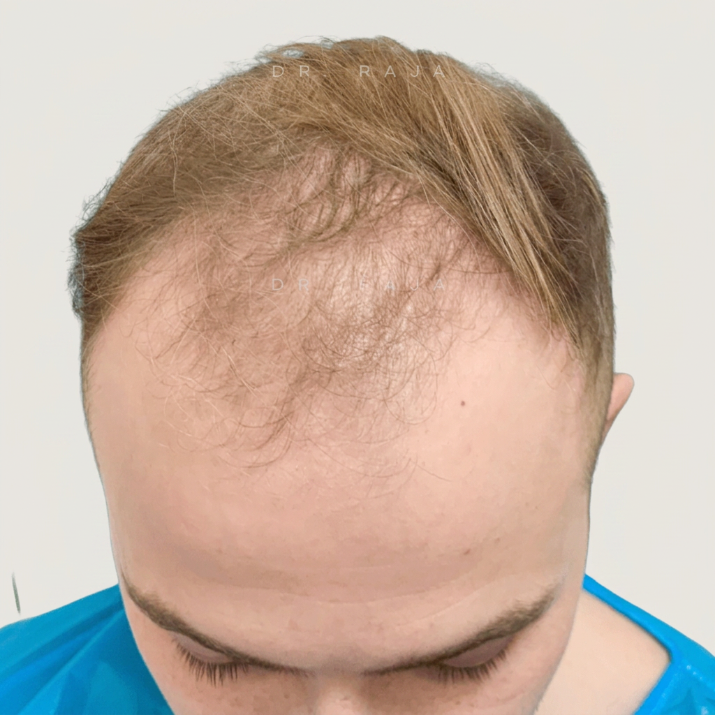 Before — hair transplant
